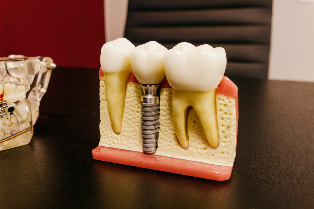 zobni implantati cena